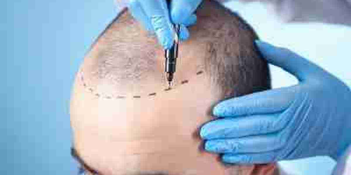 Crowning Glory Buraydah's Path to Hair Transplant Perfection