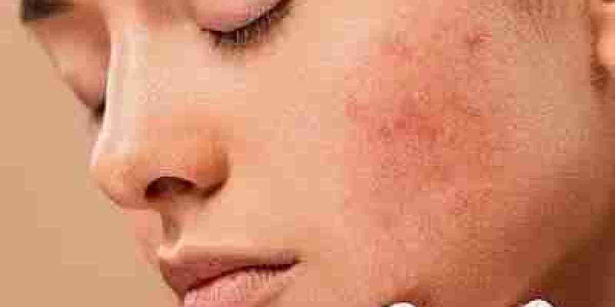 Saying Goodbye to Acne Scars: Discover the Best Treatments in Dubai