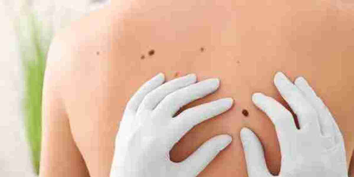 Mole Removal Treatment in Dubai: Surgery, Aftercare & Scars
