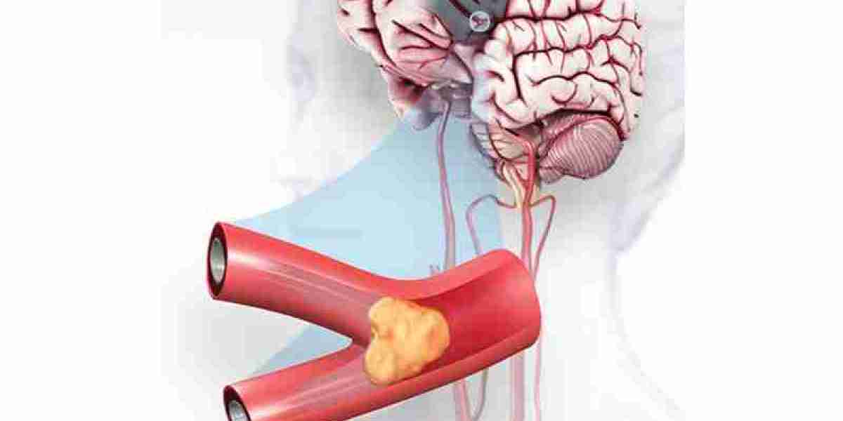 Global Acute Ischemic Stroke Diagnosis and Treatment Market Report, Latest Trends, Industry Opportunity & Forecast t