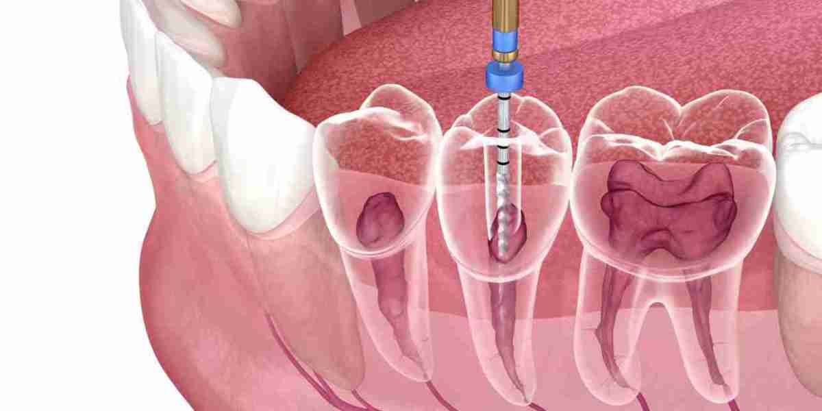 Expert Endodontists in Dubai: Your Guide to Root Canal Specialists
