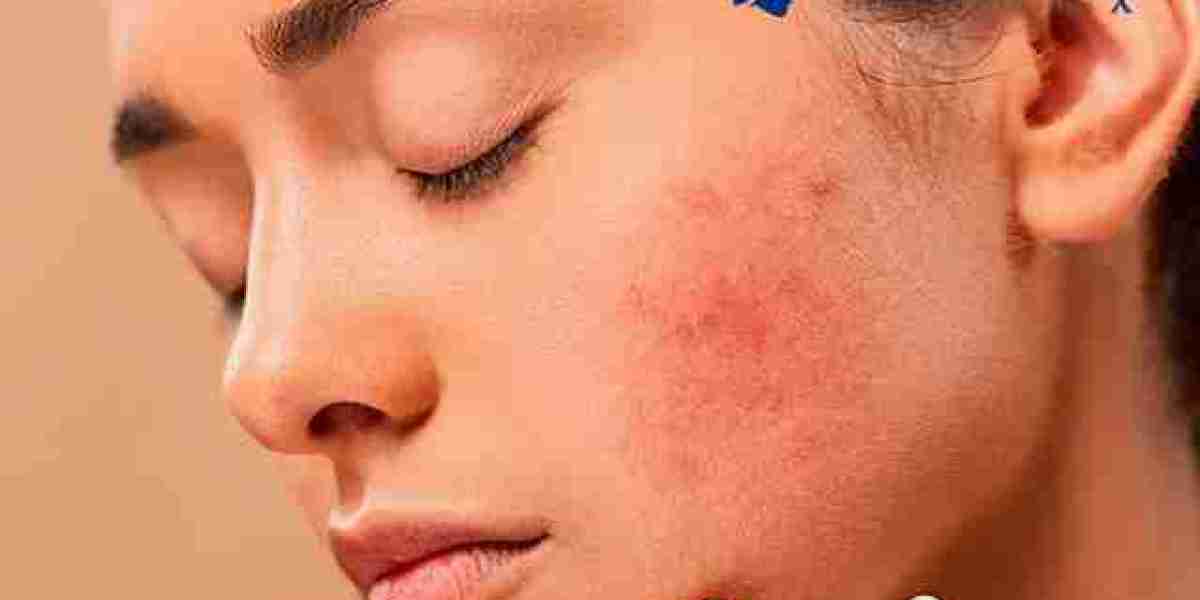 Effective and Safe Treatment for Acne