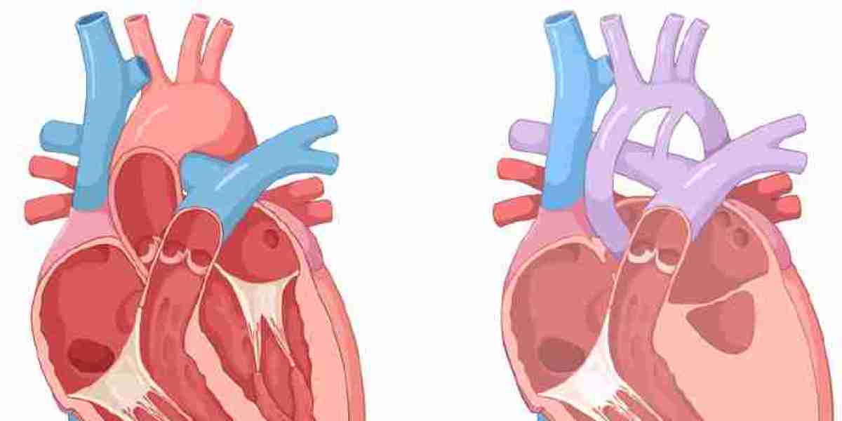 Hypoplastic Left Heart Syndrome Market 2024: Epidemiology, Industry Trends, Opportunity and Forecast by 2034