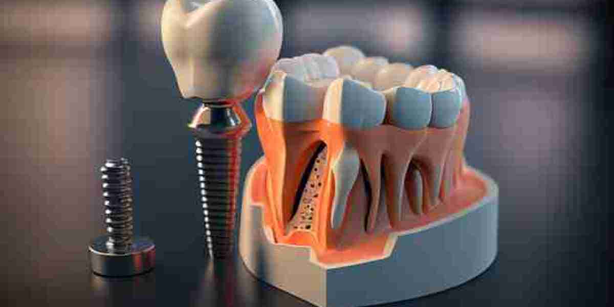 Dental Implants And Prosthetics Contract Manufacturing Market Size, Share, Growth, Opportunities and Global Forecast to 