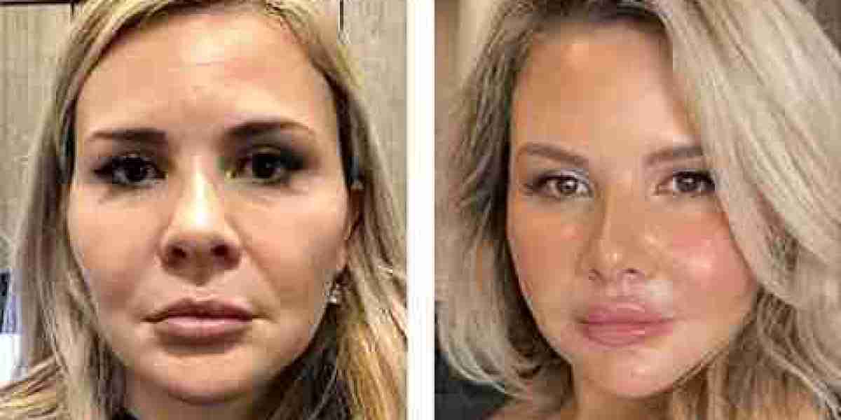 Timeless Beauty: Discover the Power of Facelift Procedures