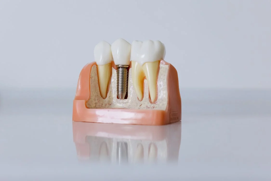 How To Find The Best Dental Implant In Los Angeles: smileagaindent — LiveJournal