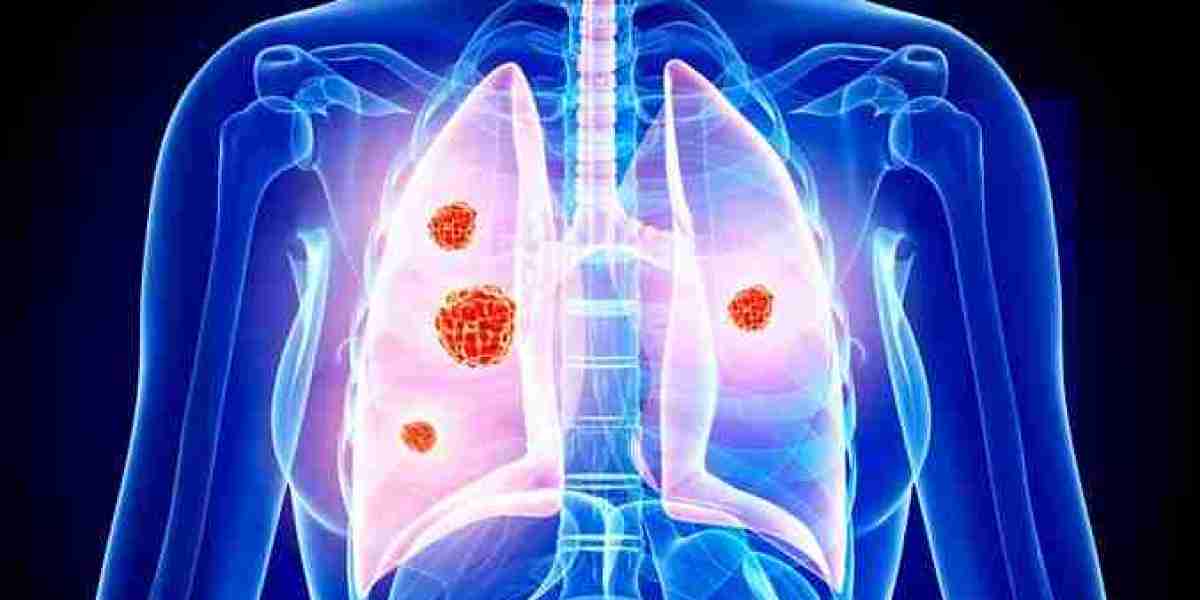 Non-Small Cell Lung Cancer (NSCLC) Market Size 2024: Epidemiology, Industry Trends and Forecast by 2034