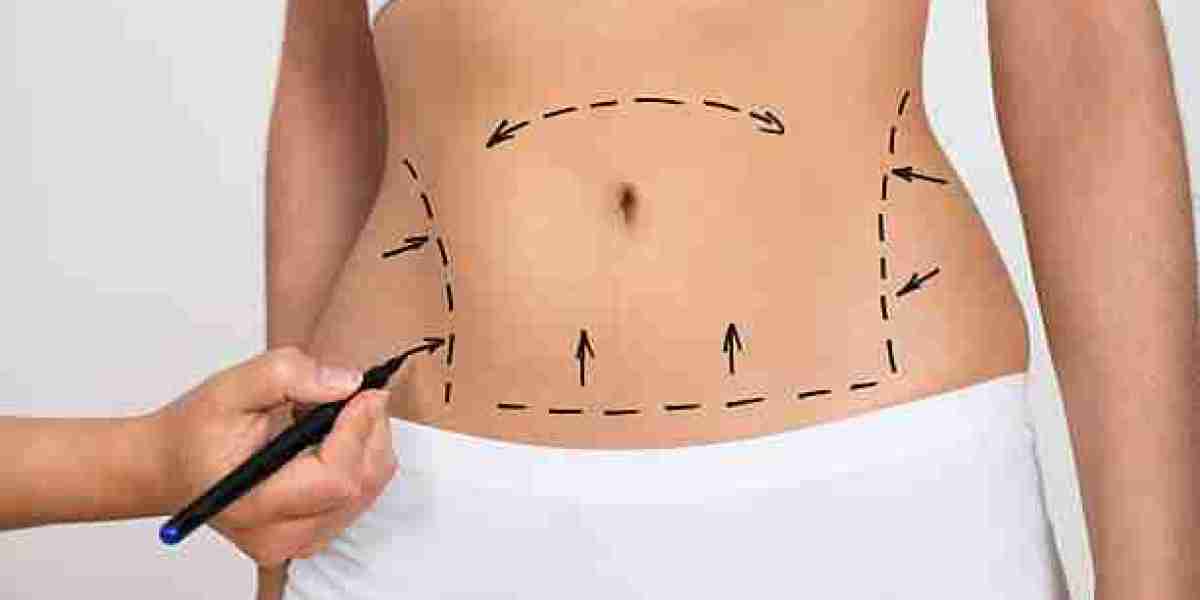 Liposuction Surgery in Dubai: Expertise You Can Trust