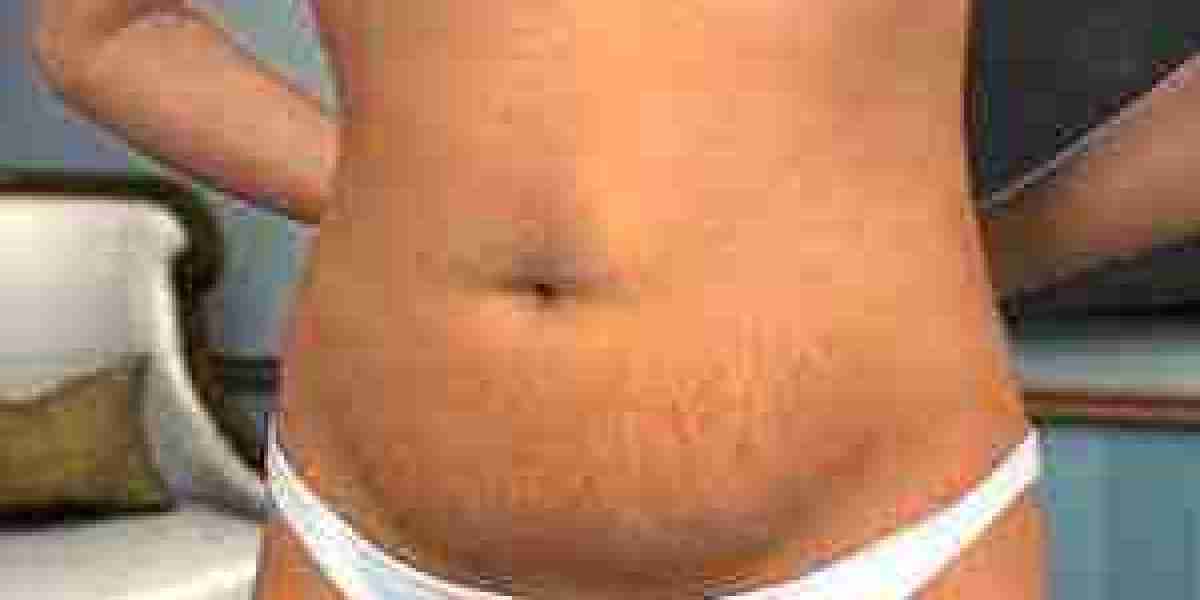 The Journey to Self-Confidence: Tummy Tuck Surgery in Riyadh