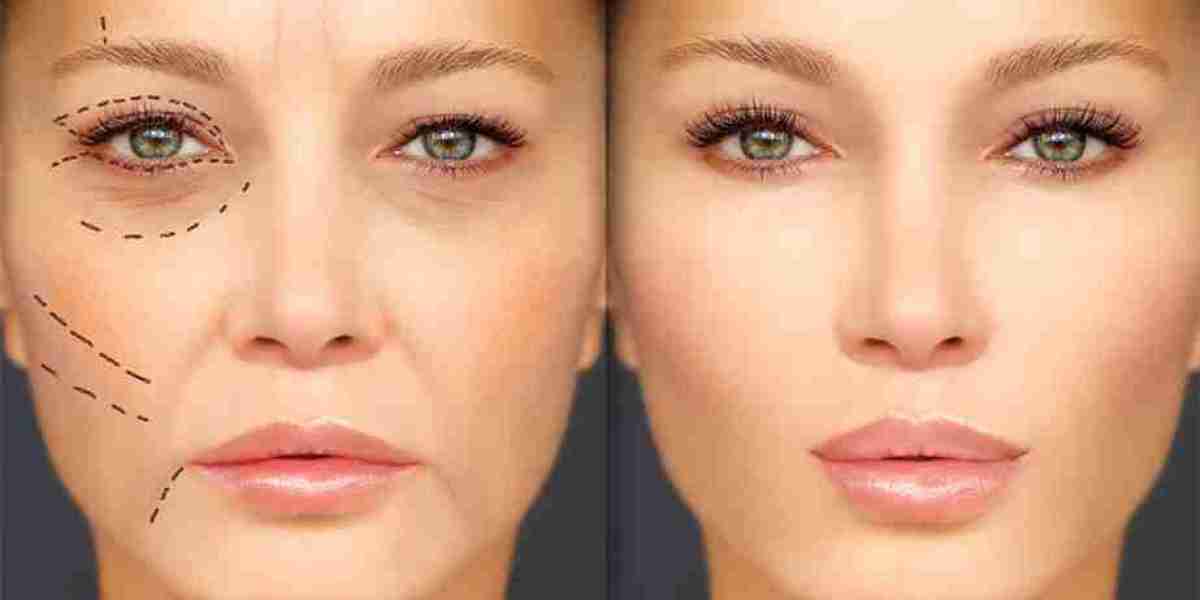 Fillers: Contraindications, Side Effects and Precautions