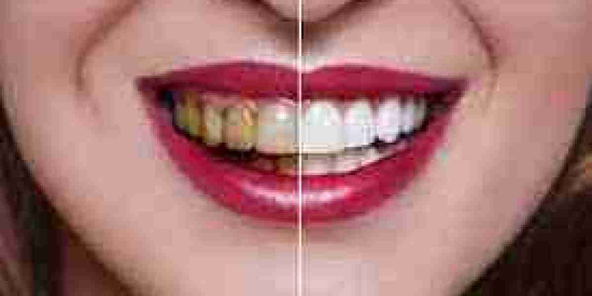 Understanding Teeth Discoloration: Causes and Prevention