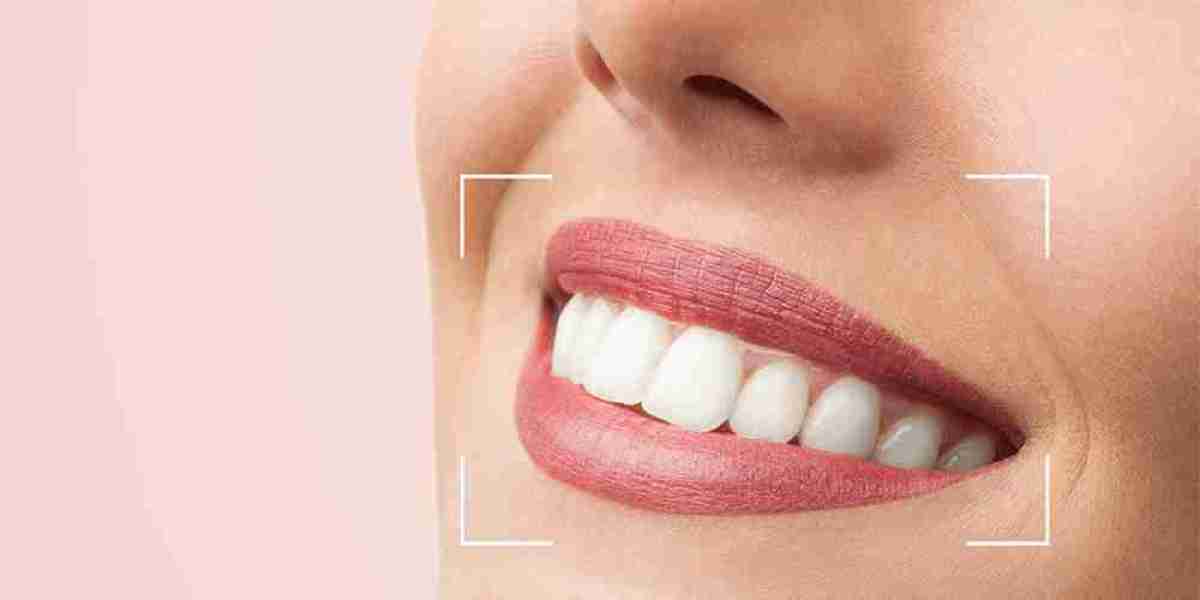 Top Procedures for a Hollywood Smile Makeover
