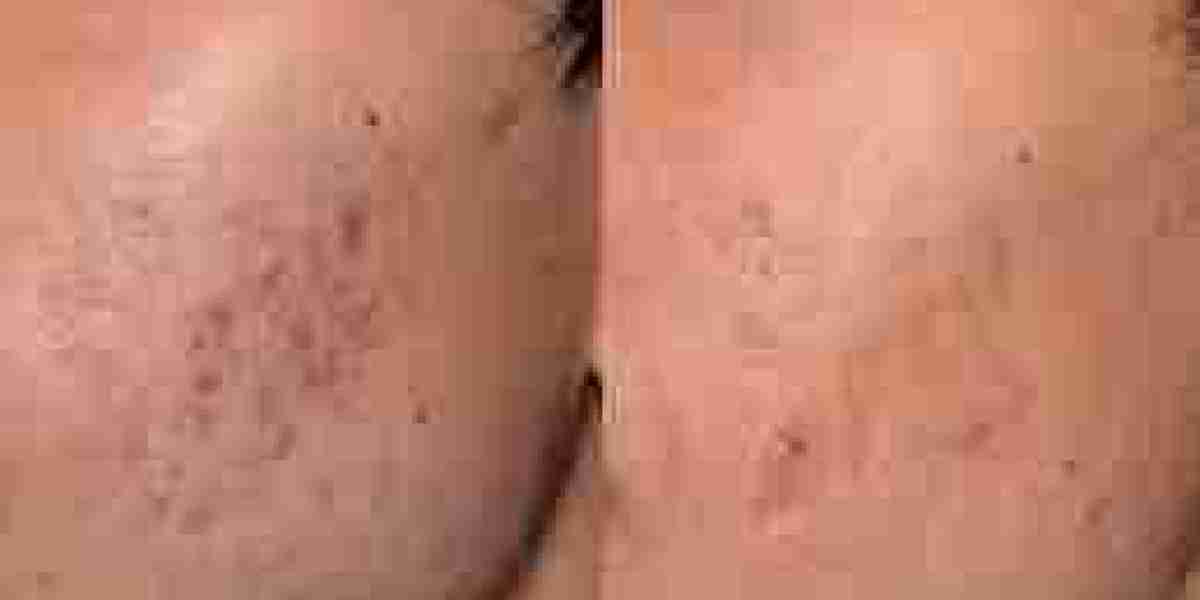Reveal Your Best Skin: Pico Laser Transformation