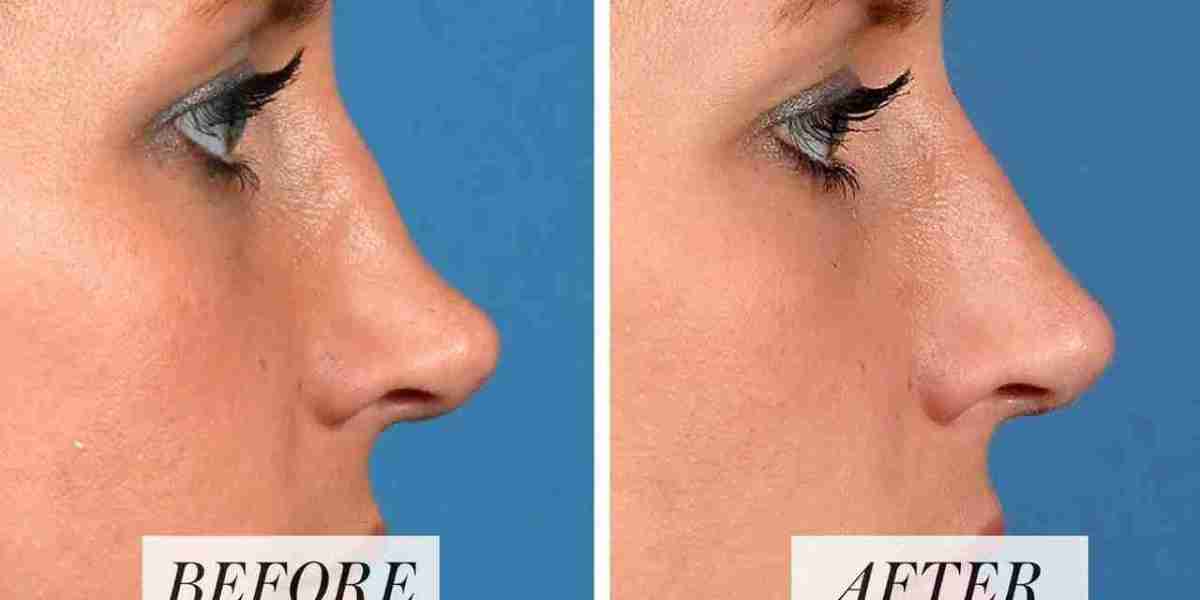 Rediscover Confidence: Dermal Filler Nose Reshaping Services