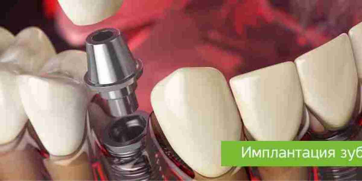 Имплантация зубов в Днепре: Процедура в клинике "UADenta"