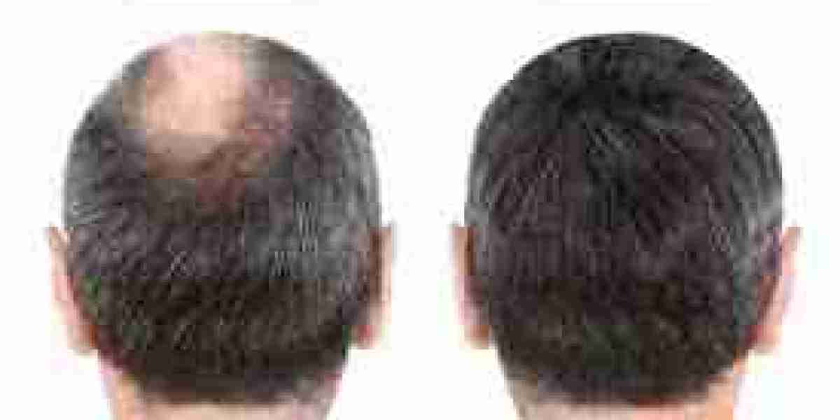 More Than Skin Deep: The Emotional Liberation of Hair Transplants