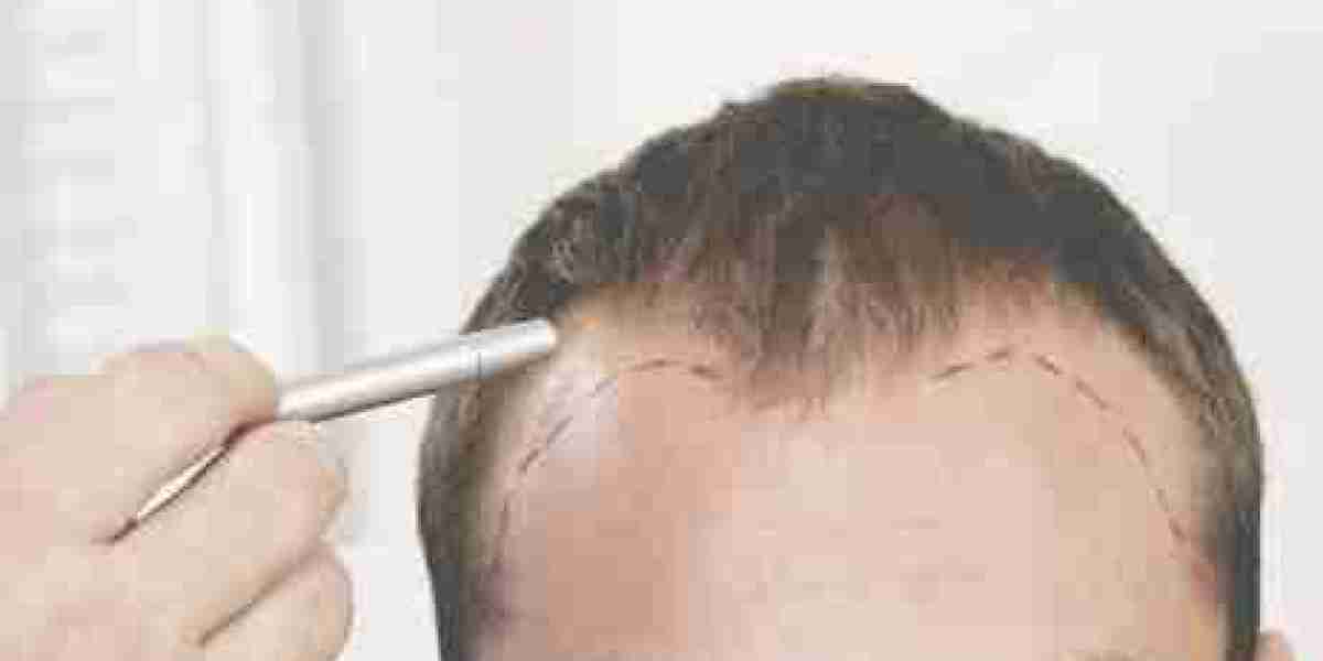 Experience Natural Results: Hair Transplant in Muscat
