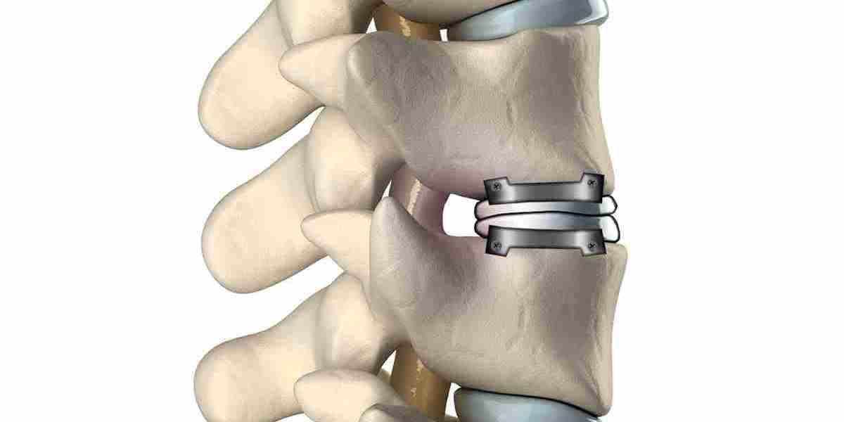 Cervical Total Disc Replacement Market Analysis, Business Development, Size, Share, Trends, Industry Analysis