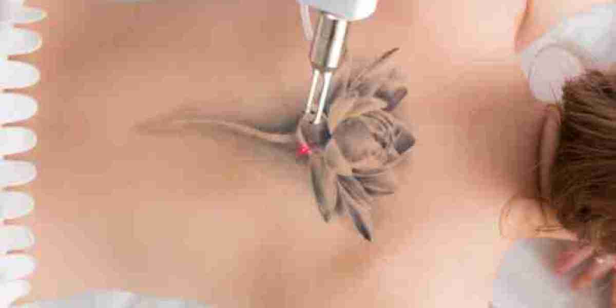  A Clean Canvas: The Art of Permanent Laser Tattoo Removal