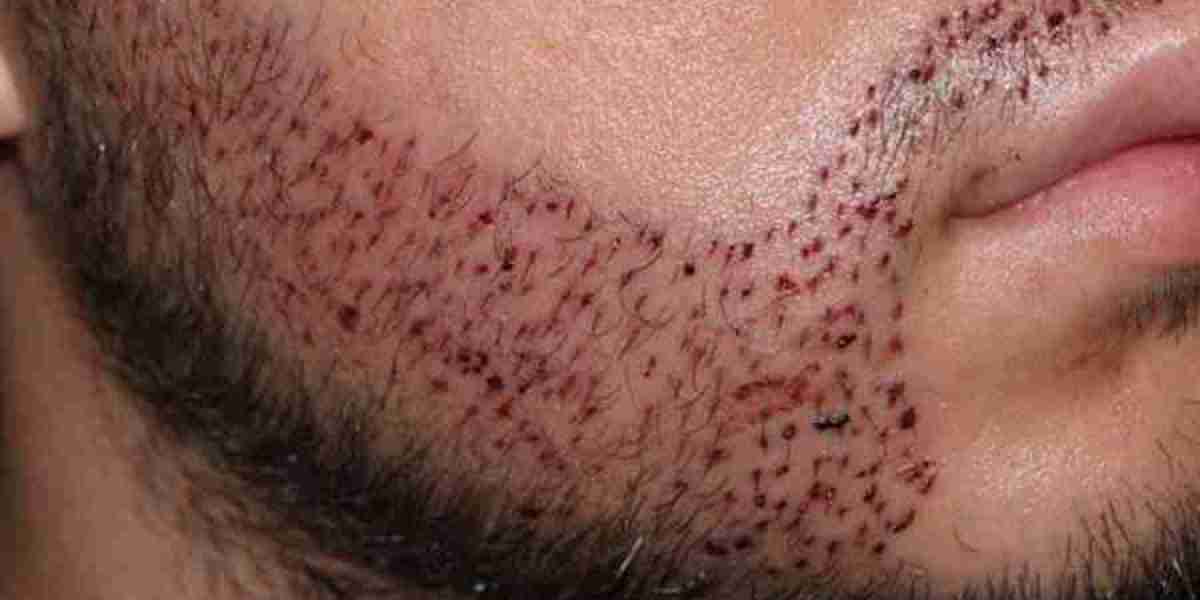 The Real Deal Beard Hair Transplant Costs in Riyadh Exposed