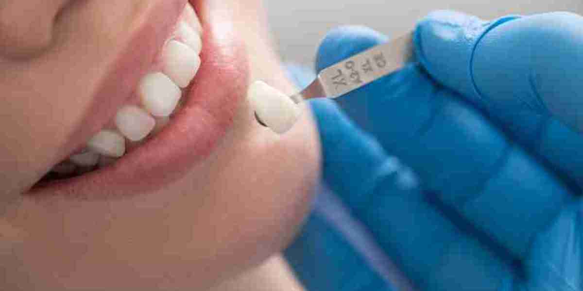A Step-by-Step Guide to Getting Ceramic Crowns in Dubai