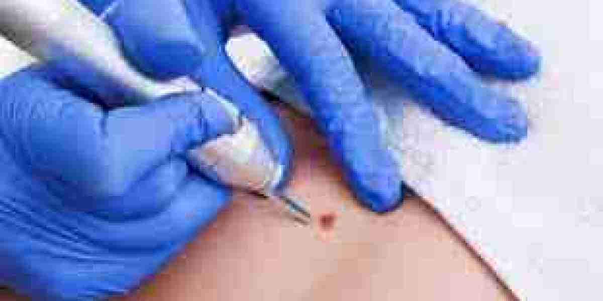 10 Surprising Facts About Skin Tags and Their Removal