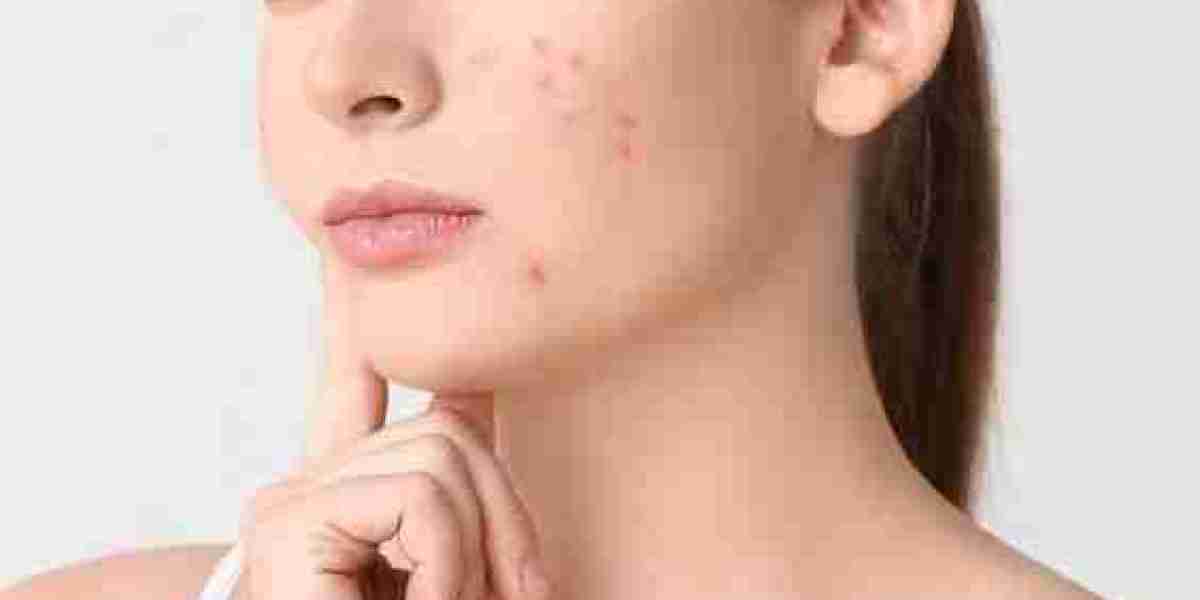 How to Treat Acne Scars for Clearer Blemish Free Skin