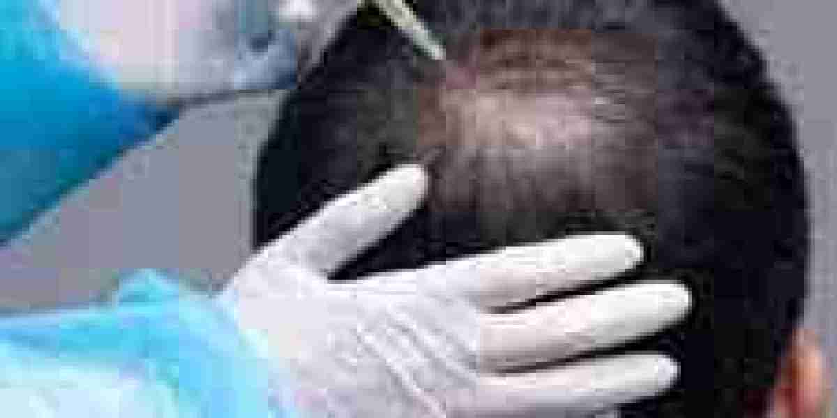  Dubai's Secret to Luscious Locks: Exploring Hair Loss Treatments