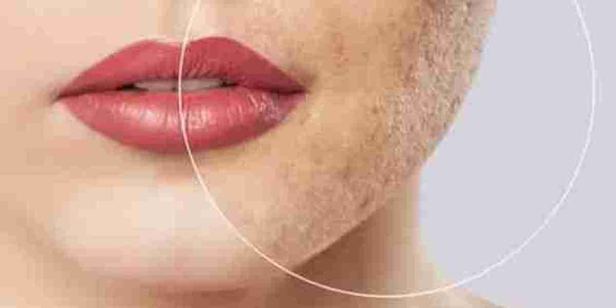 Must-Try Techniques: Hypertrophic Scars Removal in Dubai