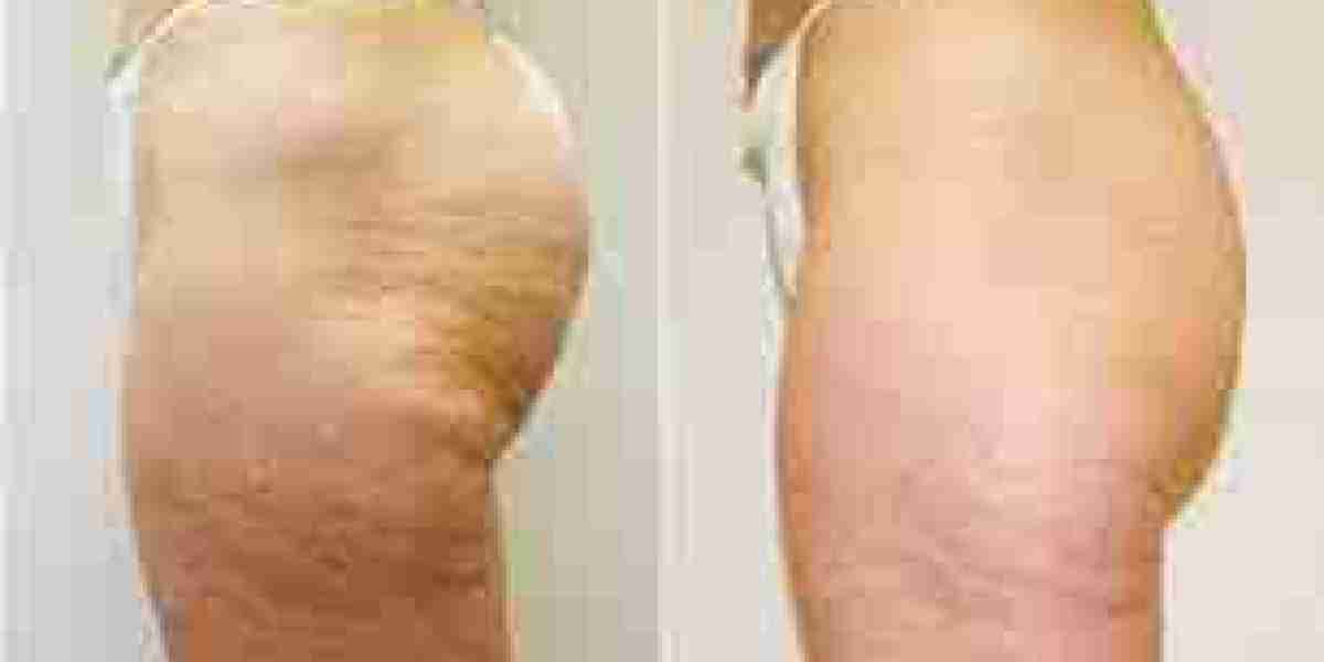Contours Reimagined: Expert Cellulite Removal Strategies