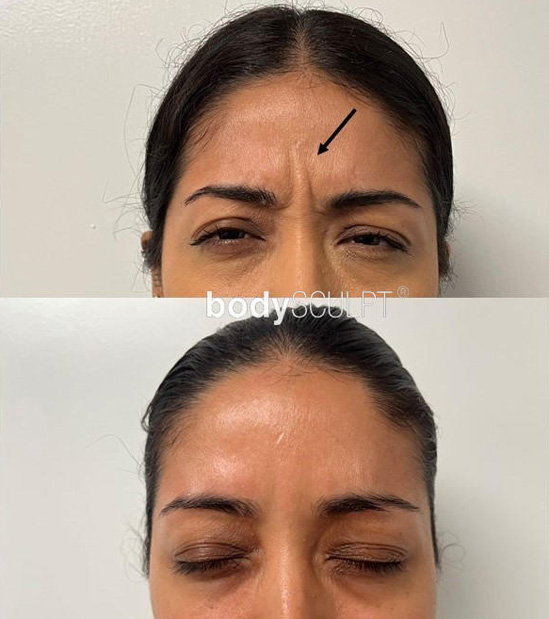 Injectables Before and After Photos - Botox Injections