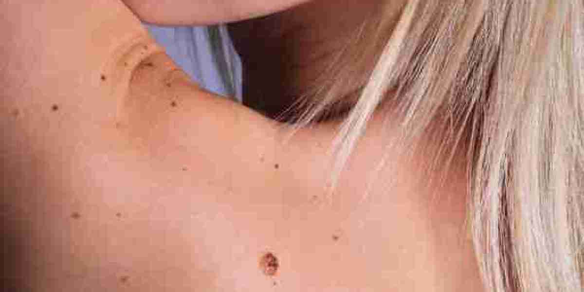 Mole Removal: What Happens, How It's Done, and More