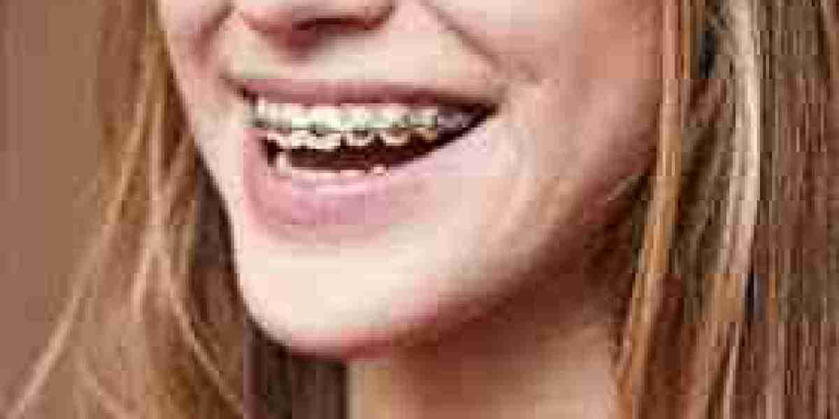 How Dental Braces Can Improve Your Oral Health in Dubai: A Comprehensive Guide