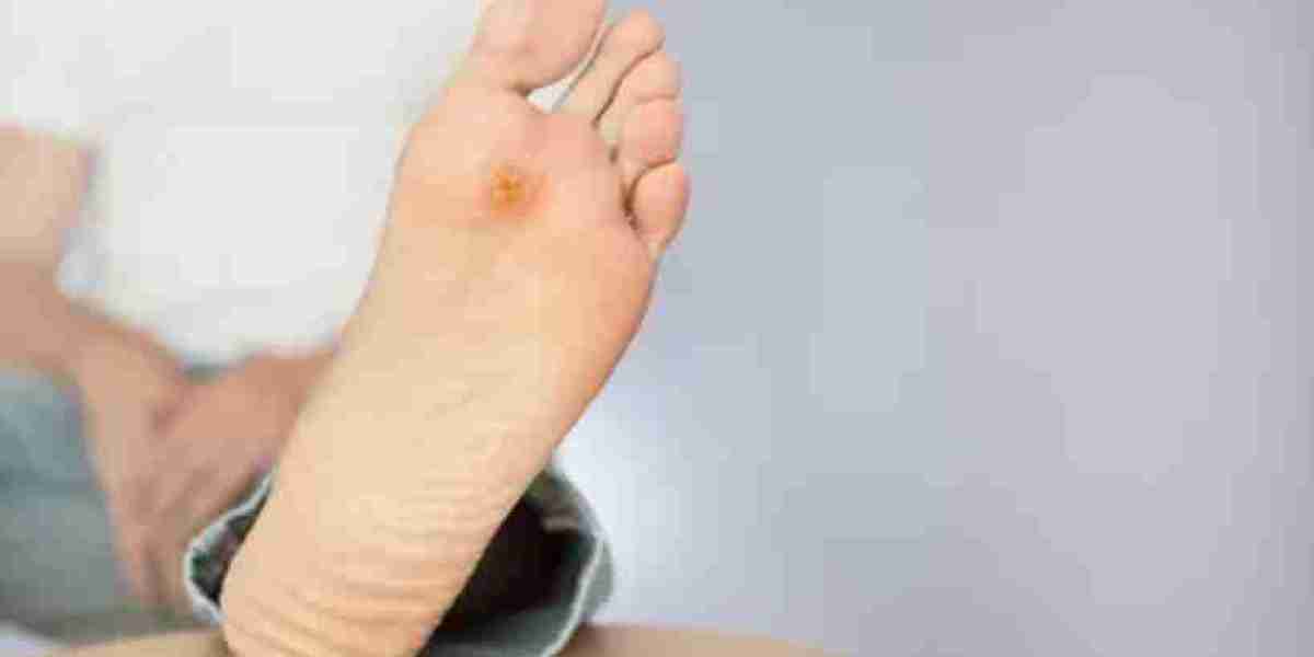 Diabetic Foot Ulcer market Share, Trend and Forecast 2030
