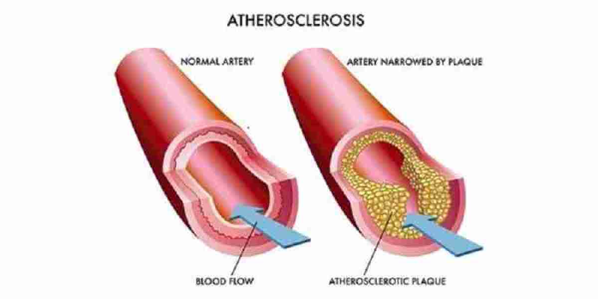 Atherosclerosis Market: Epidemiology, Trends, Demand, Share, Size (2024-2034)