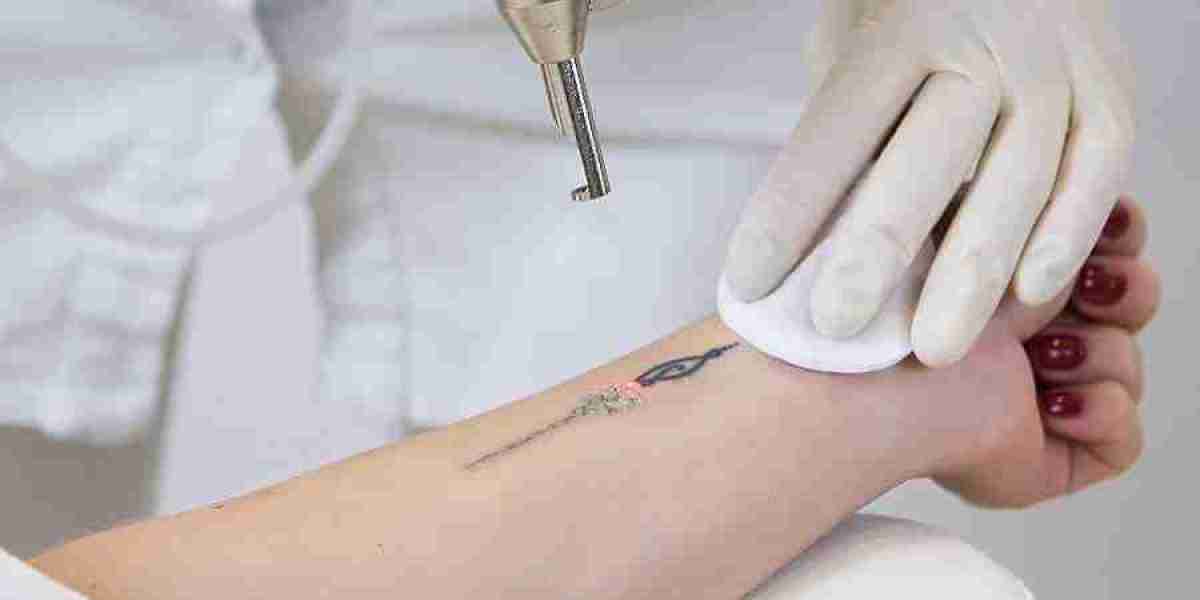 Reveal Renewal Riyadh's Hidden Gem for Laser Tattoo Removal