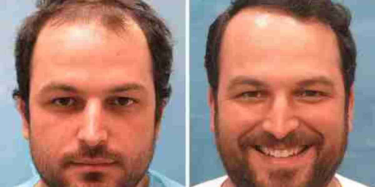Celebrity Secrets: Stars Who Have Undergone Beard Hair Transplants in Dubai