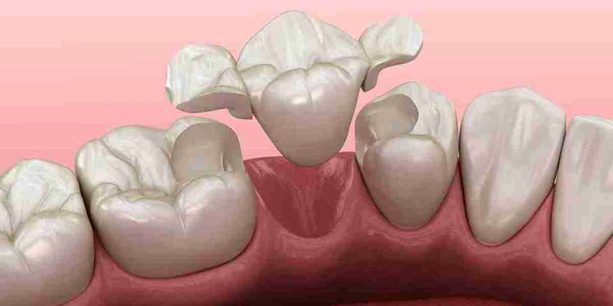 Dental Crowns and Bridges Market is Set To Fly High in Years to Come