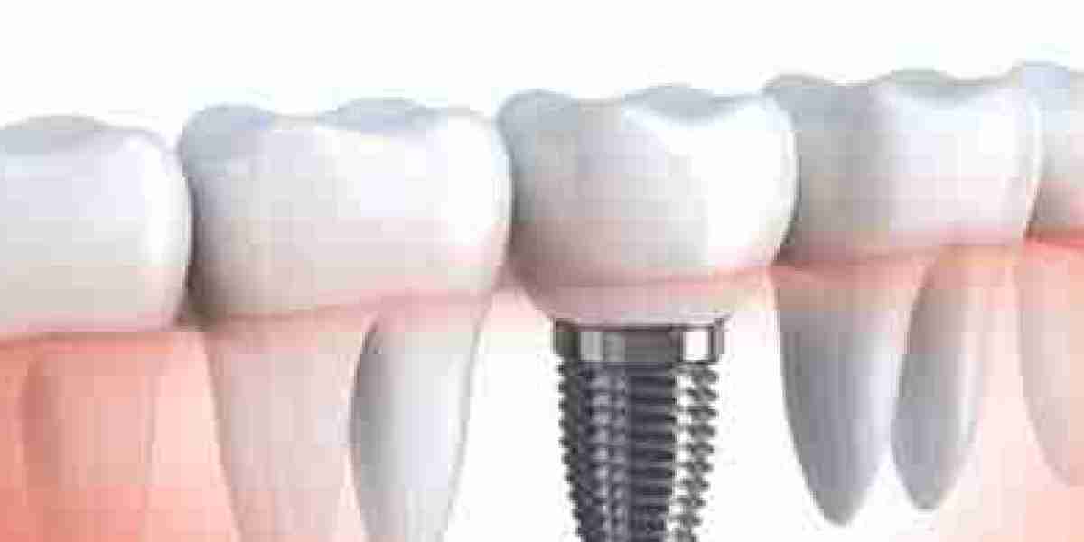 U.S. Dental Implants Market - Better Time Ahead