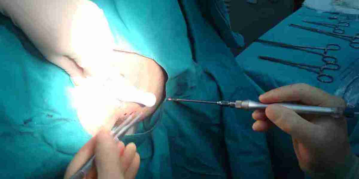 How Does Fistula Surgery Work?
