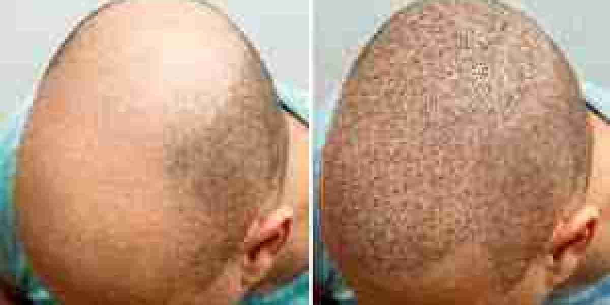 Hair Transplant Market is Set to Fly High in Years to Come