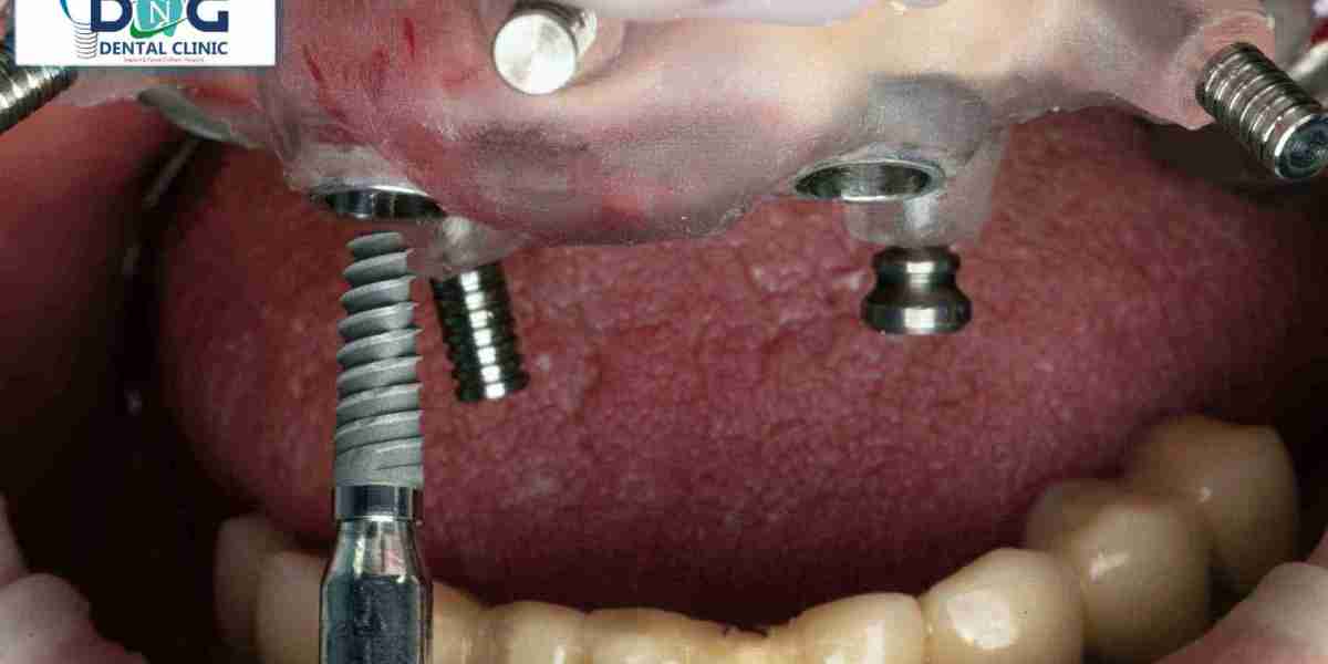 Full Mouth Dental Implant In Jaipur - A Definitive Guide To Your New Smile