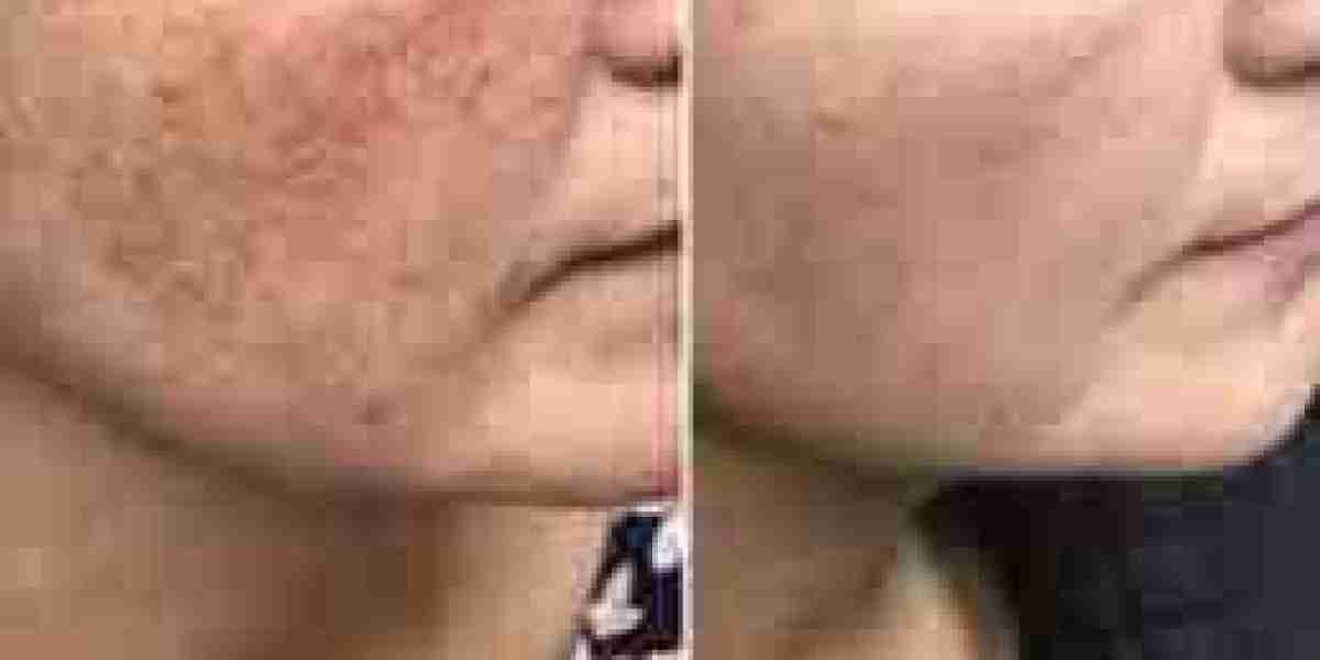 Complementary Therapies for Melasma: Boosting Treatment Results Naturally