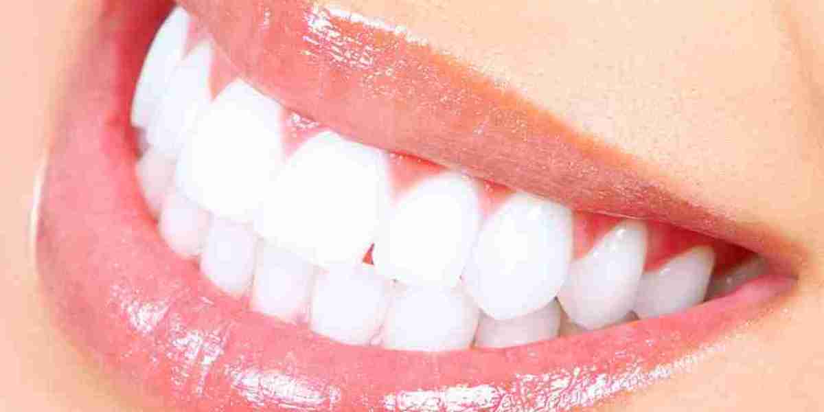 اكتشف أفضل تبييض الأسنان في دبي: دليلك الشامل لابتسامة أكثر إشراقاً!
