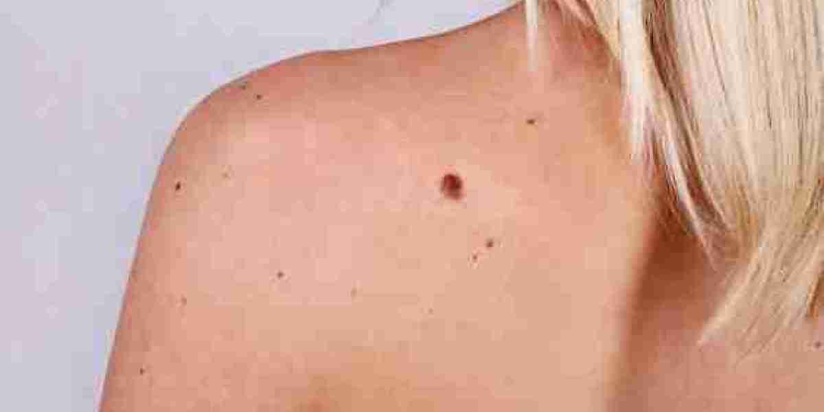 Best Methods To Remove Skin Tags on Eyes