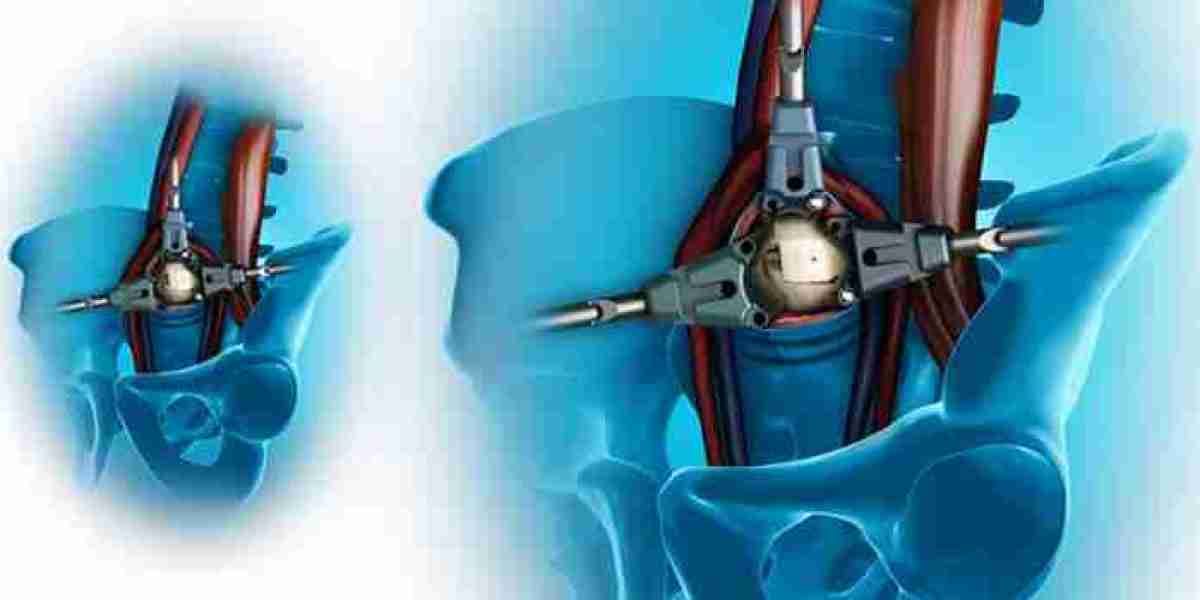 Spinal Fusion Devices Market Trends, Future Growth 2030