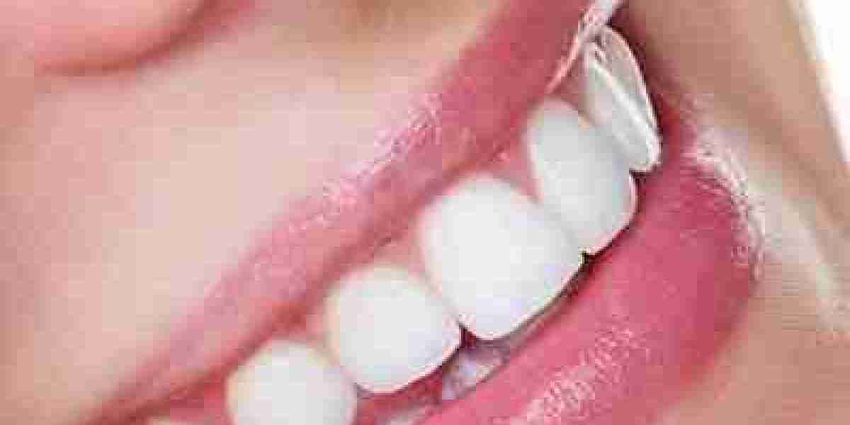 The Complete Handbook to Teeth Whitening Services Available in Dubai