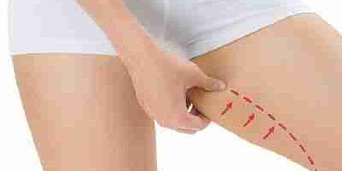 6 Common Myths About Thigh Lifts in Dubai Debunked