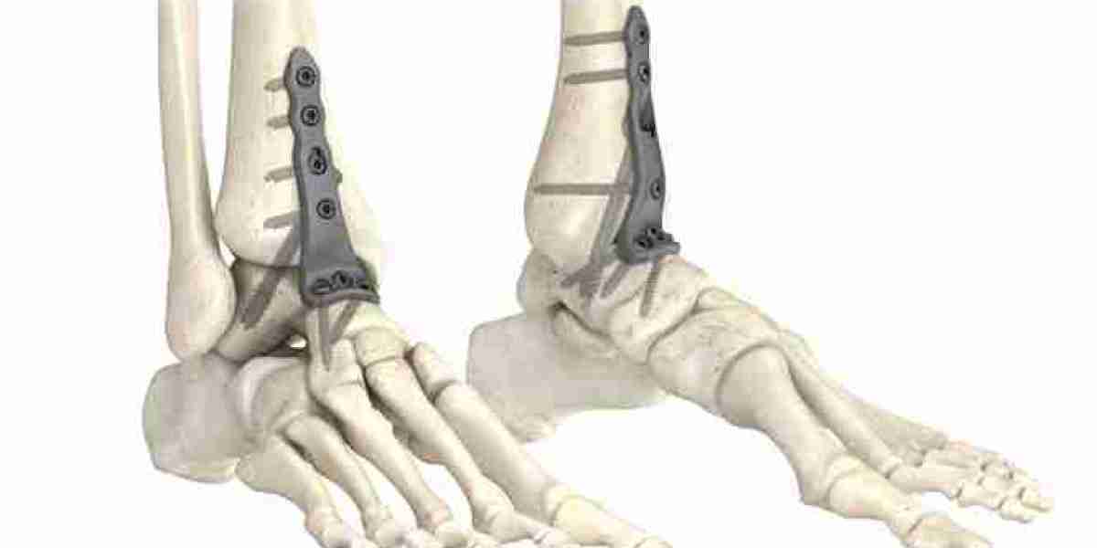 Arthrodesis Plates Market May Set New Epic Growth Story