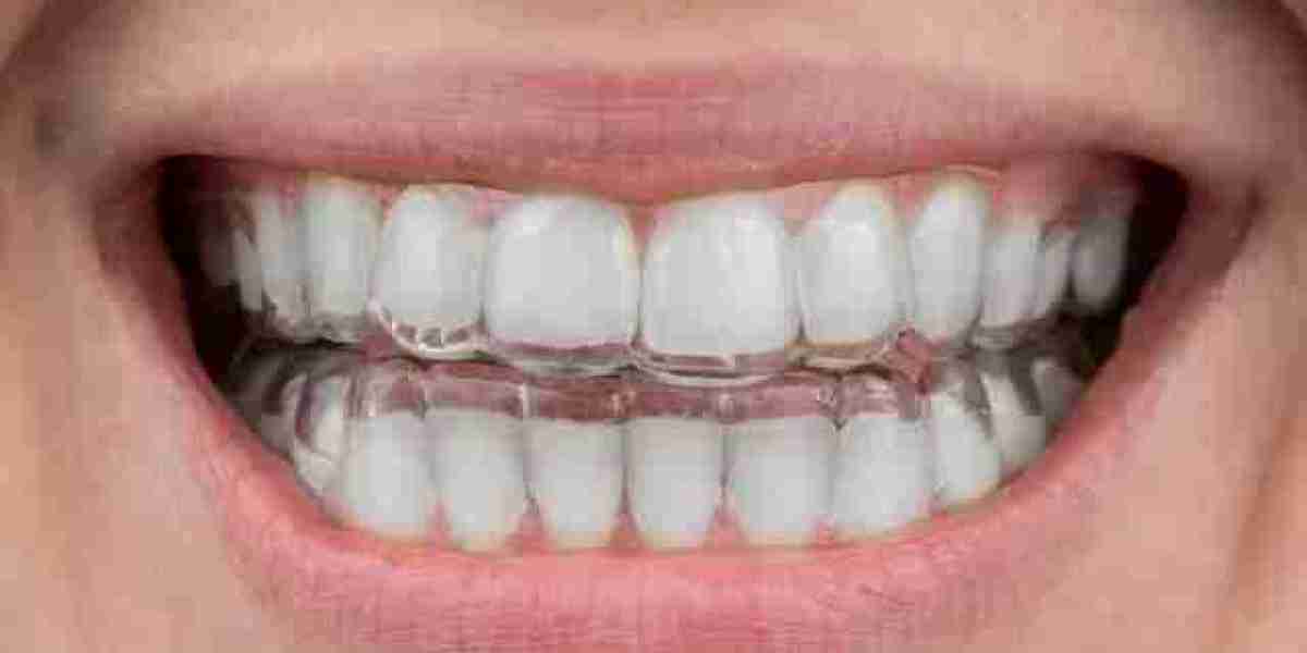 Clear Aligners Market: Ready To Fly on high Growth Trends
